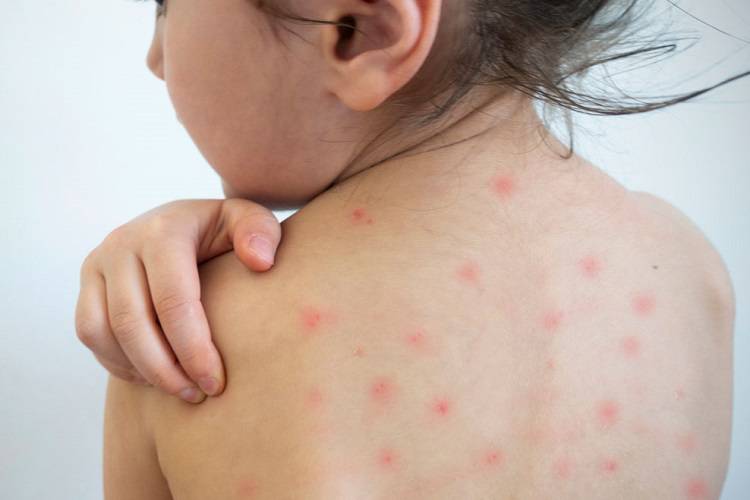 زنگ خطر شیوع سرخک به صدا در آمد سرخک