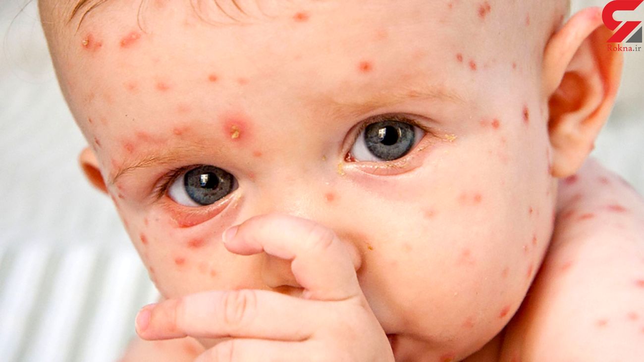 این افراد نگران آبله میمون نباشند این افراد نگران آبله میمون نباشند