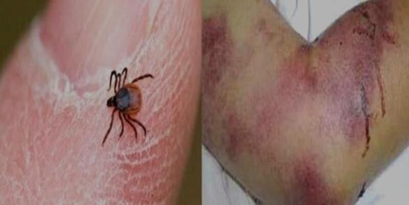 شناسایی بیماری تب کریمه کنگو در ۱۶ استان کشور شناسایی بیماری تب کریمه کنگو در ۱۶ استان کشور